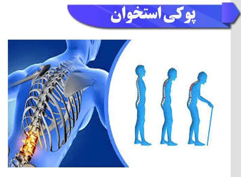 روش‌های درمان  و پیشگیری از پوکی استخوان چیست؟