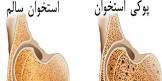 پیشگیری از پوکی استخوان