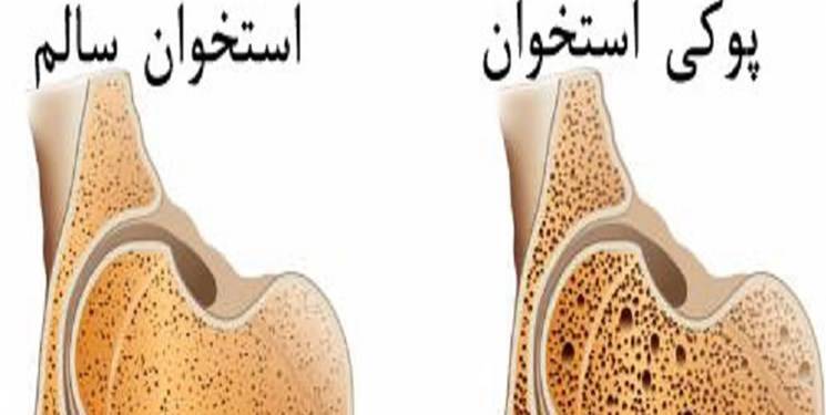 عوامل موثر بر پوکی استخوان
