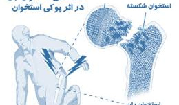 کنفرانس علمی یکروزه پیشگیری ، تشخیص و درمان استئوپوروز