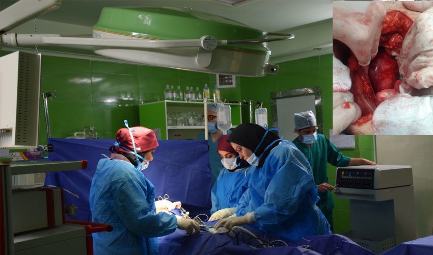 جراحی موفق خارج کردن کیست کبدی در بیمارستان محلات