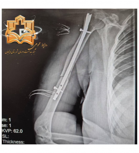دلیجان دومین شهرستان استان مرکزی در عمل جراحی بازو(میله درون استخوانی)