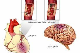 تفاوت های علائم سکته  قلبی و  سکته  مغزی