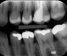 ارسال تصاویر رادیولوژی تک دندان به سامانه پکس دانشگاه
