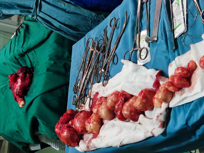 جراحی حساس میومکتومی و هیسترکتومی بر روی  بیمار مبتلا به کیفوز و بیماری زمینه ای قلب با موفقیت انجام شد.
