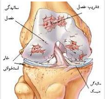 درمان تق تق زانو با طب سنتی