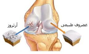 برنامه تلویزیونی پزشک شما با موضوع انواع آرتروز و علل آن