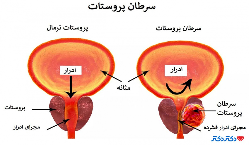 سرطان پروستات