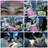 انجام عمل جراحی استرابیسم  ( لوچی چشم ) در مرکز آموزشی درمانی امیرکبیر